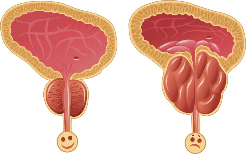 síntomas de prostatite nos homes